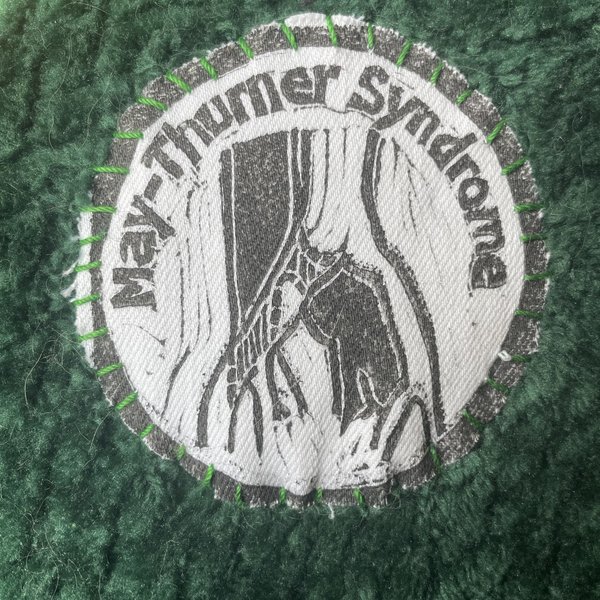 May-Thurner Syndrome Patch